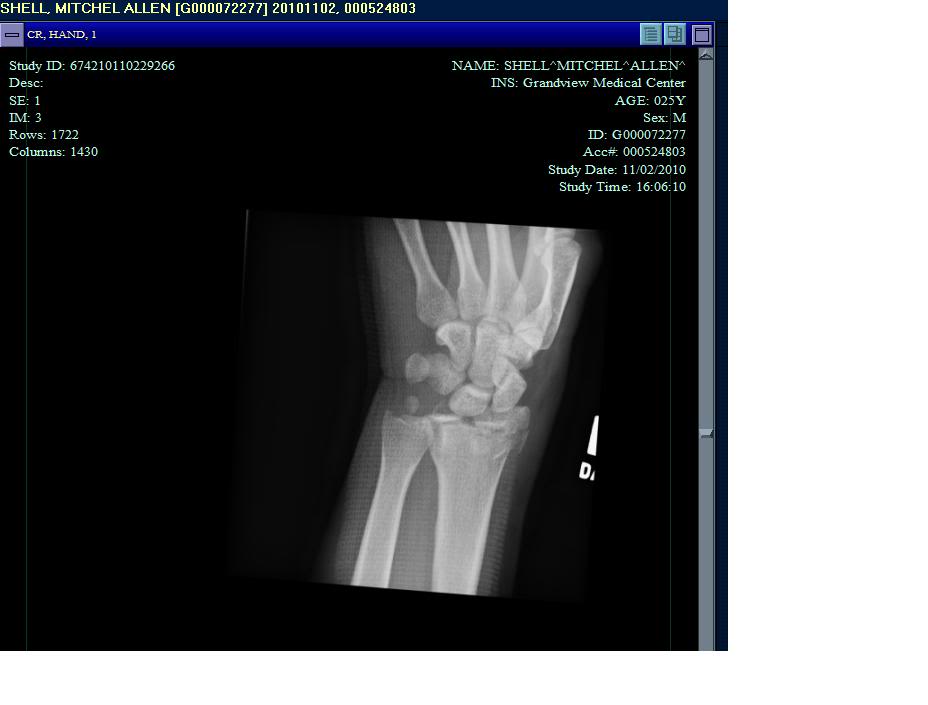 Name:  brokenwrist2.jpg
Views: 23
Size:  39.7 KB